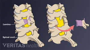 Posterior view of the cervical spine showing the cervical laminectomy labeling the lamina and spinal cord.
