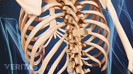 Posterior view of compression fracture bandage location in the vertebra.