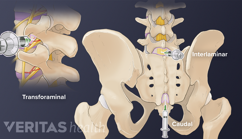 Sitio de inyección de inyecciones transforaminales, interlaminares y caudales en la médula espinal.