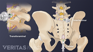 Ubicaciones de inyección epidural transforaminal, interlaminar y caudal en la región lumbar