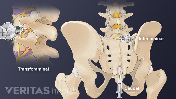 The injection site of transforaminal, interlamniar, and caudal injections in the spinal cord