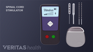 Spinal Cord Stimulator placement showing controller, leads and generator.