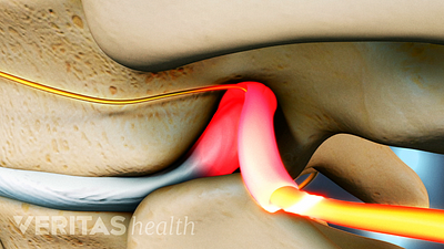 How Soft Tissue Injuries Cause Neck Strain