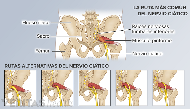 La vía del nervio ciático más común y otras 5 variaciones anatómicas de la vía del nervio.
