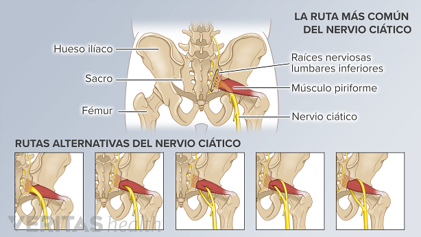La vía del nervio ciático más común y otras 5 variaciones anatómicas de la vía del nervio.