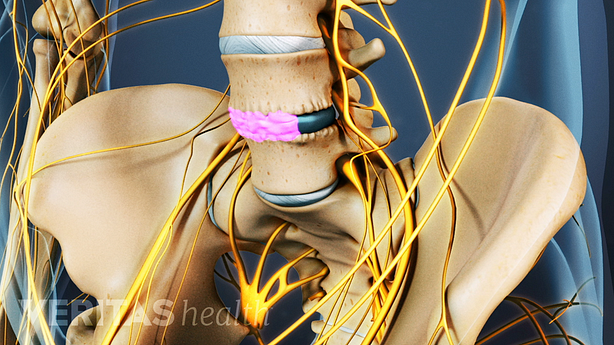 Illustration showing lumbar vertebra with bone graft between the vertebrae in pink.