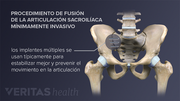 Una fusión de la articulación sacroilíaca elimina el movimiento en la articulación sacroilíaca mediante el injerto del ilion y el sacro juntos.