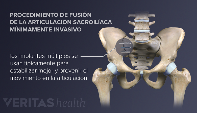 Una fusión de la articulación sacroilíaca elimina el movimiento en la articulación sacroilíaca mediante el injerto del ilion y el sacro juntos.