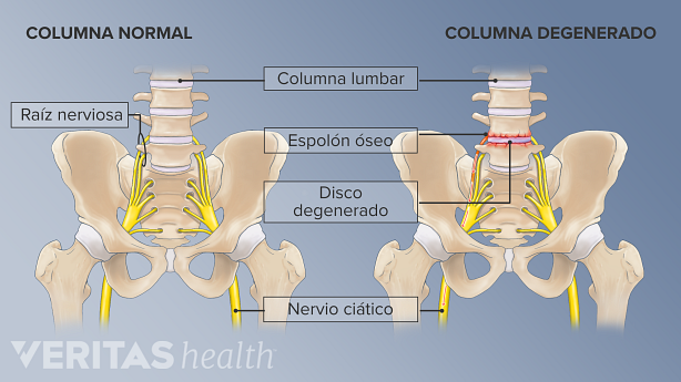 Una columna lumbar normal y una degenerada con problemas óseos y discales.
