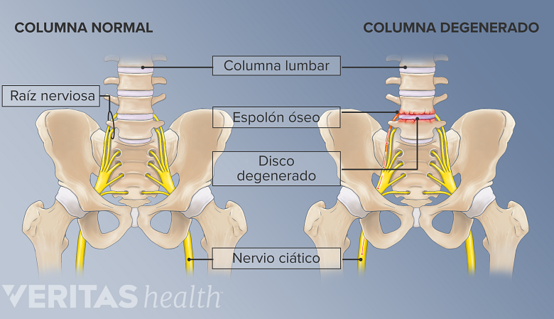 Una columna vertebral normal y una degenerativa.
