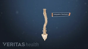 Bracing Treatment for Idiopathic Scoliosis