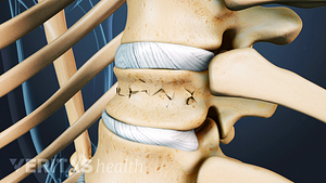 Close up medical illustration of a vertebrae with a compression fracture