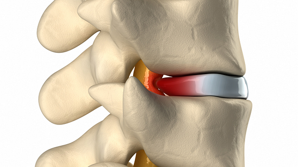 3D sagittal view of a thoracic disc herniation pressing on spinal cord.