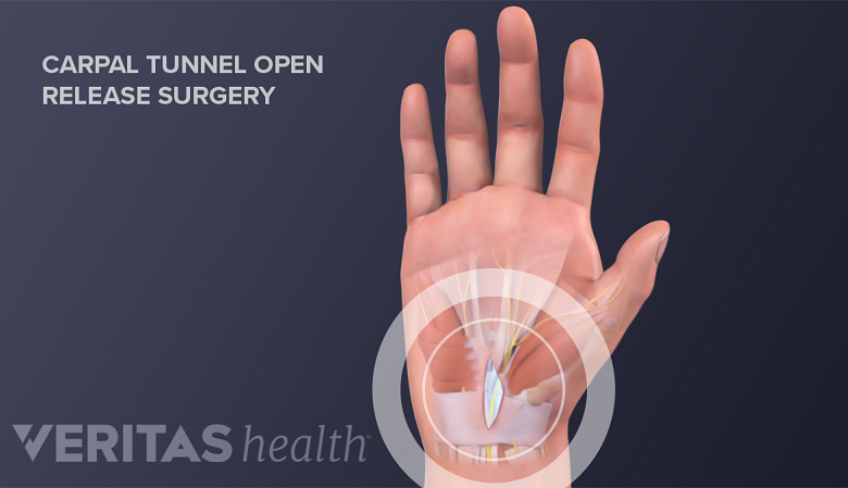 Illustration of palmer view of hand showing open release surgery.