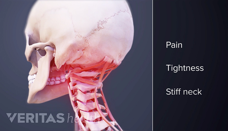 Symptoms or poor neck posture.