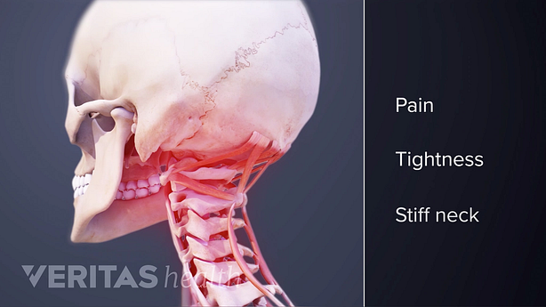 3D image of a skull and cervical spine with three types of symptoms listed.