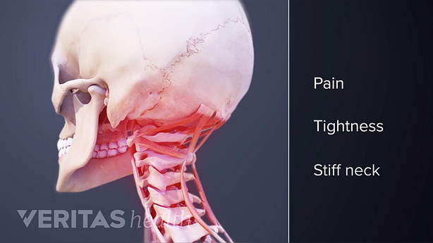 Symptoms or poor neck posture.