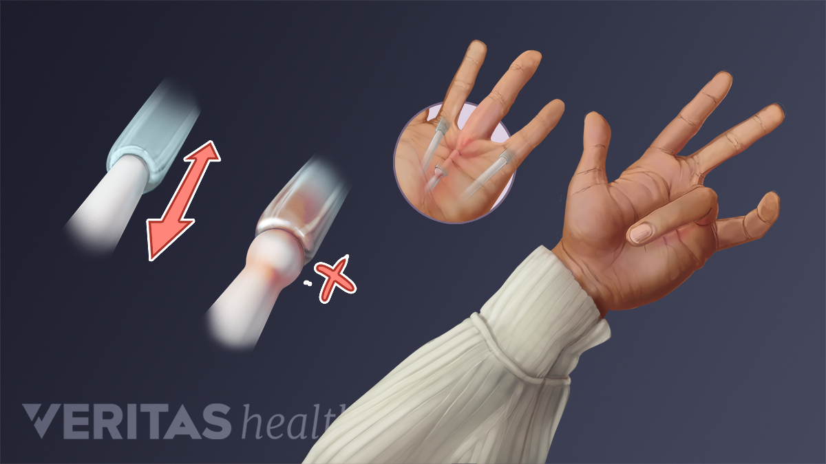 Is My Hand Pain Caused by Arthritis or Carpal Tunnel Syndrome? |  Arthritis-health