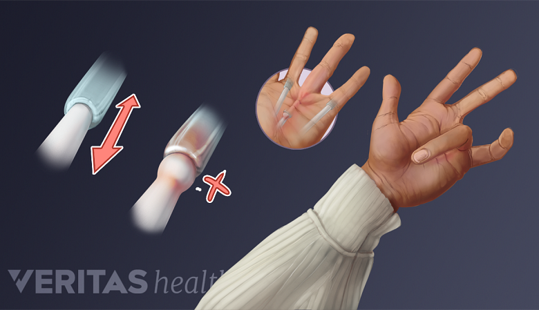 Illustration of tendon sheath inflammation and a hand with trigger finger