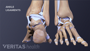 All About Foot Stress Fractures