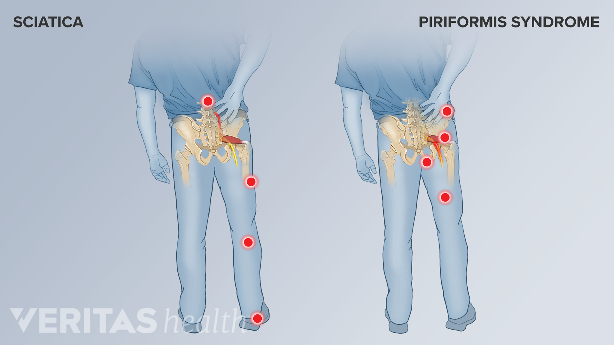 What Is Piriformis Syndrome? | Spine-health