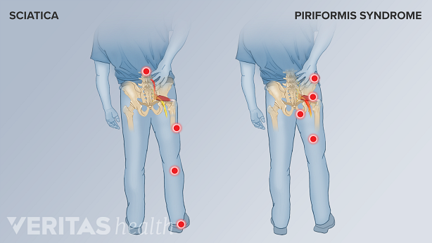 Una ilustración que muestra los puntos de dolor en la ciática frente al síndrome piriforme.