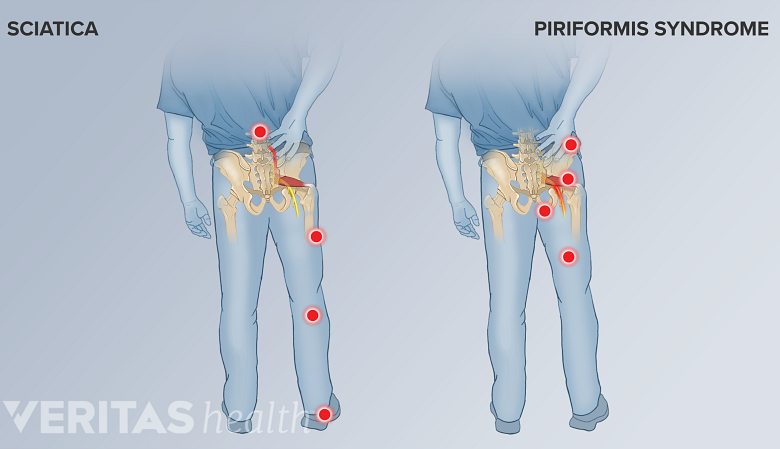 An illustration showing pain points in sciatica vs piriformis syndrome.