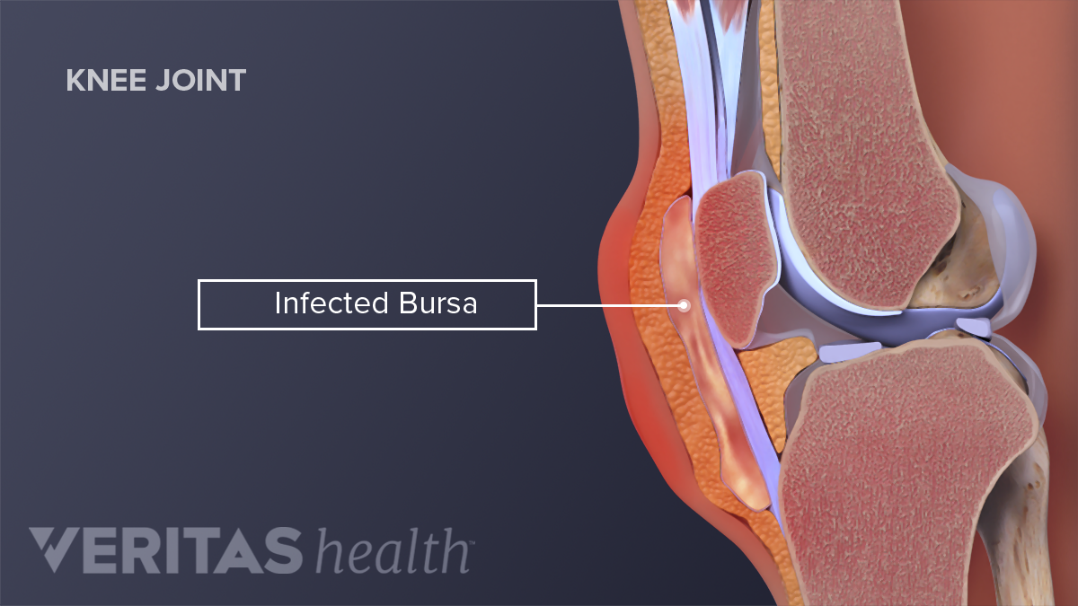 Knee (Prepatellar) Bursitis | Arthritis-health