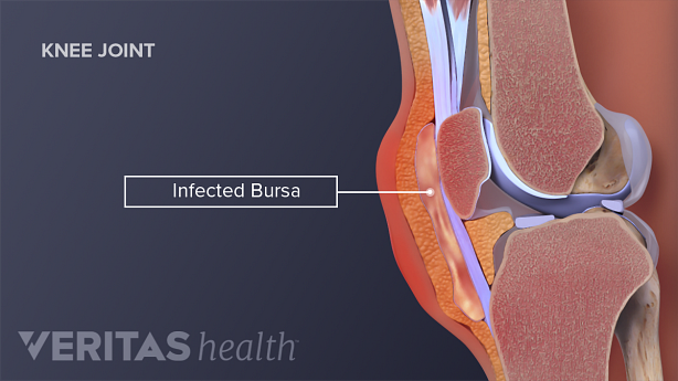 Medical illustration of infected knee bursae
