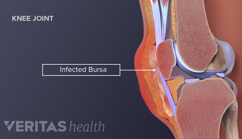 Illustration showing knee anatomy labelling inflamed bursa.