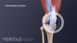 Medical illustration of inflamed, thickened knee bursa