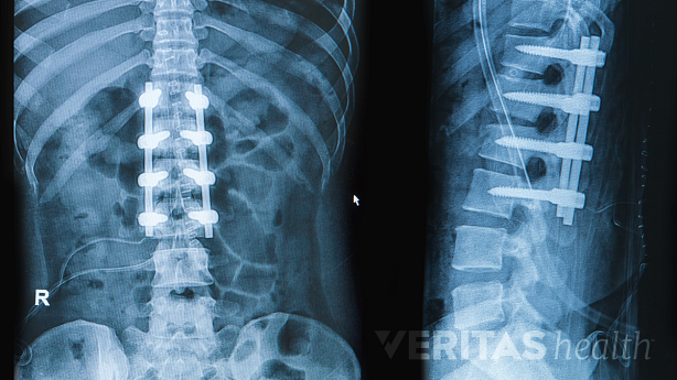 Spinal x-ray showing pedicle screws and rods across 3 spinal segments.