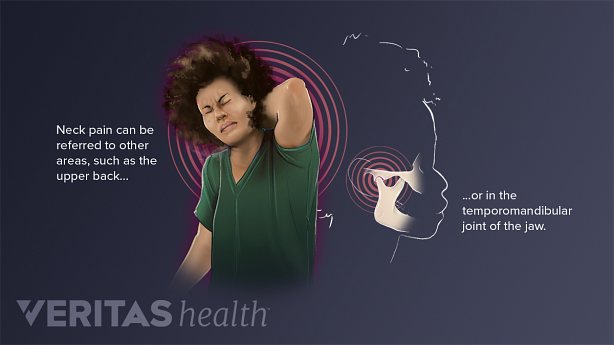 An illustration showing a woman with neck pain and TMJ pain.