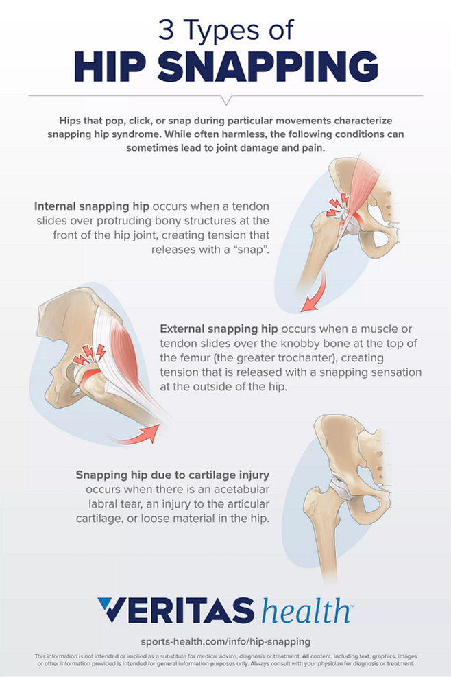 How do you treat internal snapping hip syndrome?