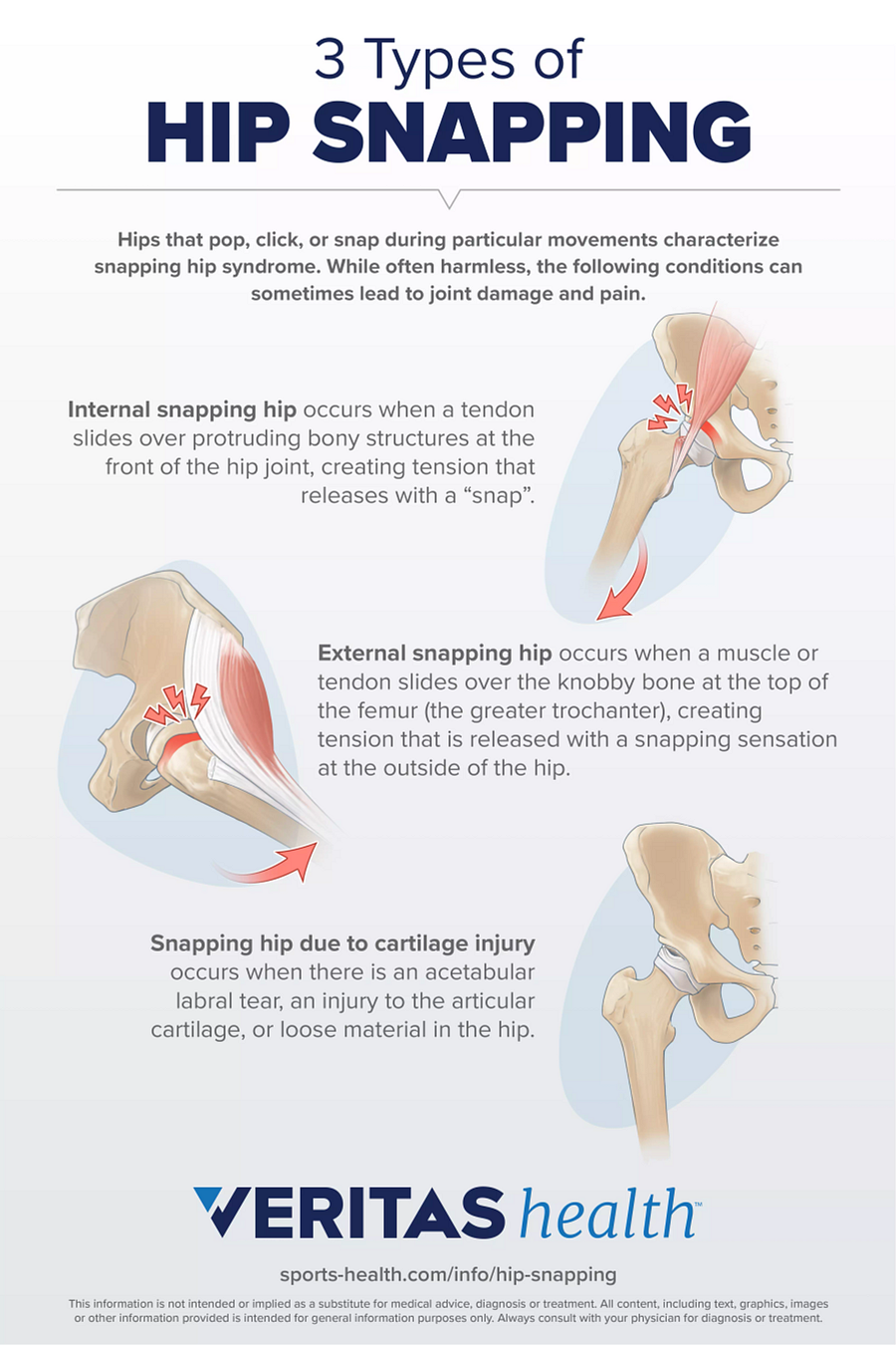 Infographic of 3 Types of Snapping Hip Syndrome