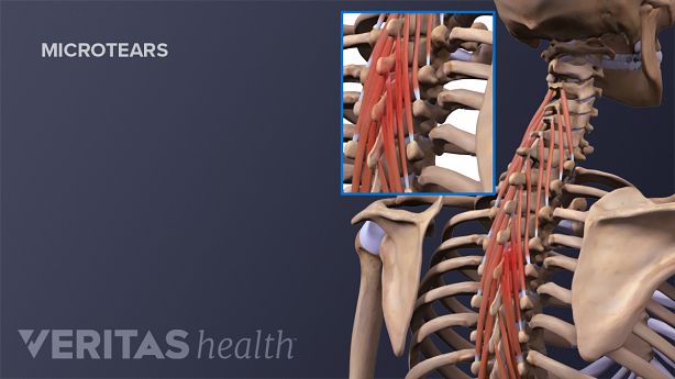 An illustration showing a adult spine with muscle tear in upper back region.