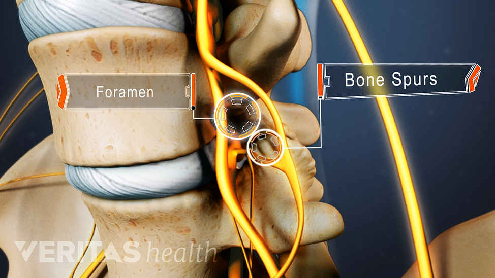 Animated video still of bone spurs impinging on nearby nerve roots