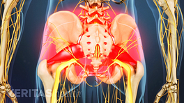 Resaltar el área de dolor del síndrome piriforme en la parte inferior de la espalda, las nalgas y el área de la cadera