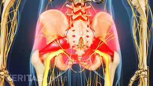 Highlighting the pain area of piriformis syndrome in the lower back, buttocks and hip area