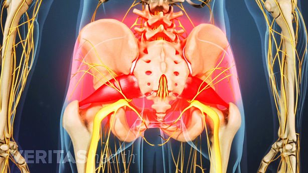 Una ilustración que muestra el área de dolor resaltada en la nalga.