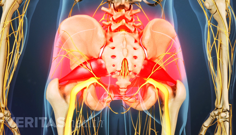 An illustration showing highlighted area of pain in the buttock.