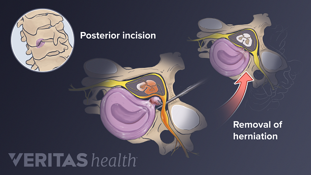 An illustration showing posterior cervical discectomy.