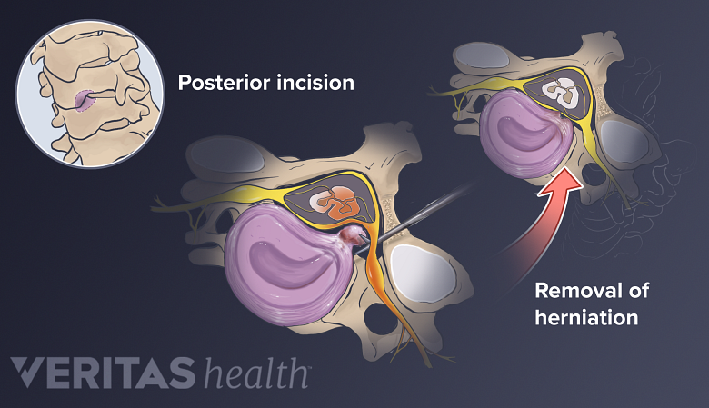 Illustration showing posrior approach cervical surgery.