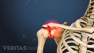 Radiating pain in clavicle of the shoulder joint