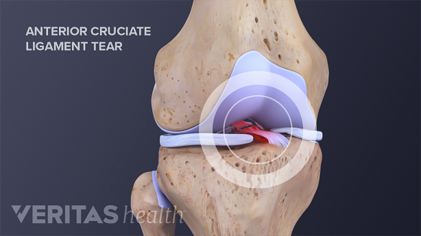 Anterior cruciate ligament tear in anterior view of the knee