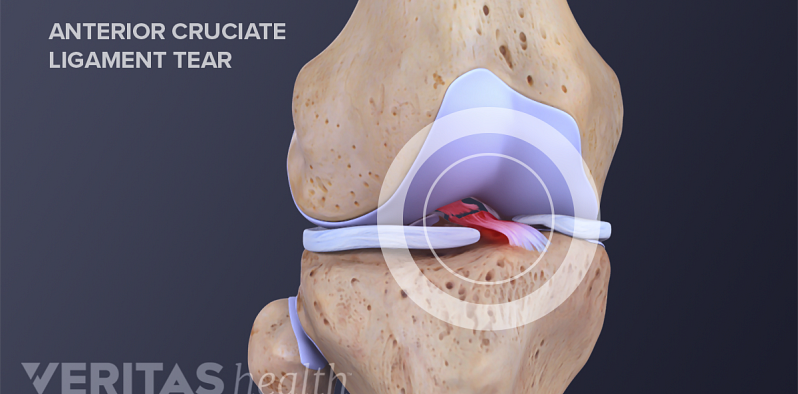 Anterior view of a torn anterior cruciate ligament (ACL) of the knee