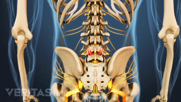 Bone spurs compressing nerve roots in the lower back.