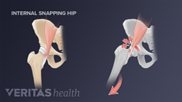 Diagnosing Hip Impingement
