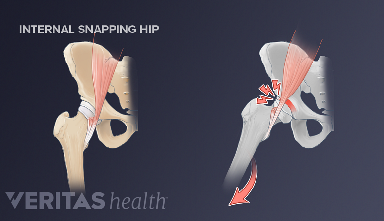 Two anterior views of the hip, one showing a snapping hip