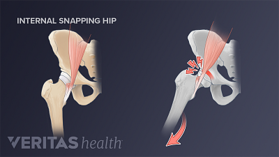 Side-by-side illustration of a stationary hip and one that is snapping as it rotates